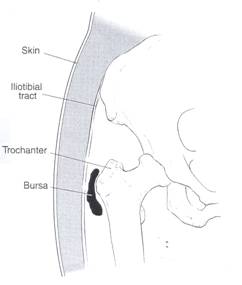 HIP TENDONITIS