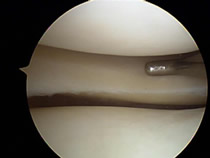 knee meniscus in perfect condition
