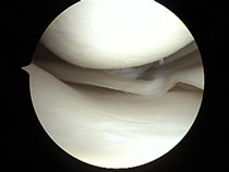torn meniscus