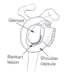 Superior labral tear, or SLAP tear